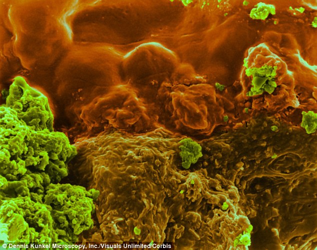 Gum disease is the result of a chronic inflammatory response to the build-up of dental plaque. This magnified photo shows an accumulation of bacterial plaque and the early formation of calcified tartar